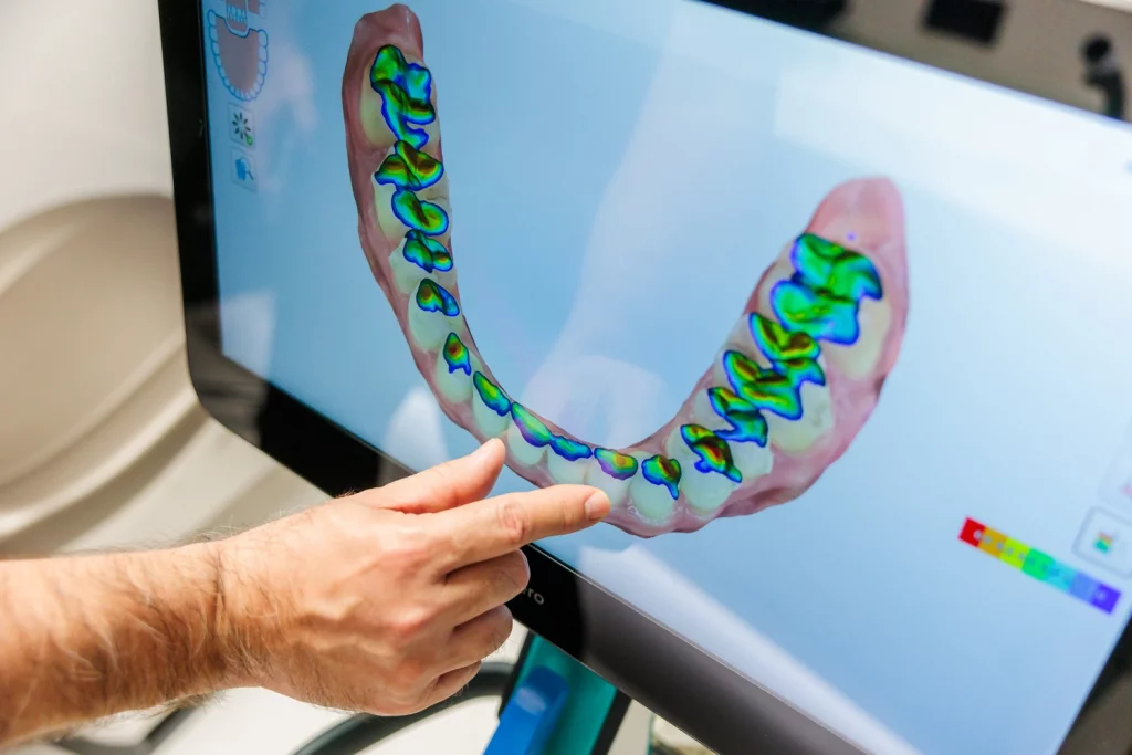 Nahezu unsichtbarer Invisalign-Aligner für die kieferorthopädische Behandlung bei B-Kö Smiles, Schadowstraße Düsseldorf